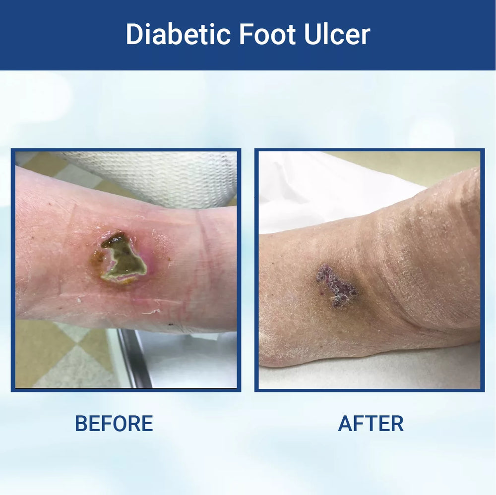 
                  
                    Diabetic Wound Gel (24 bottles/case)
                  
                