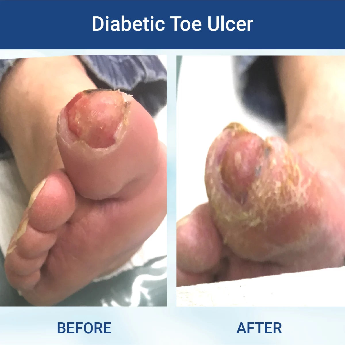 
                  
                    Diabetic Wound Gel (24 bottles/case)
                  
                